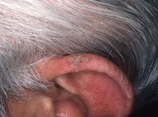Lésion hyperkératosique sur l’oreille gauche *